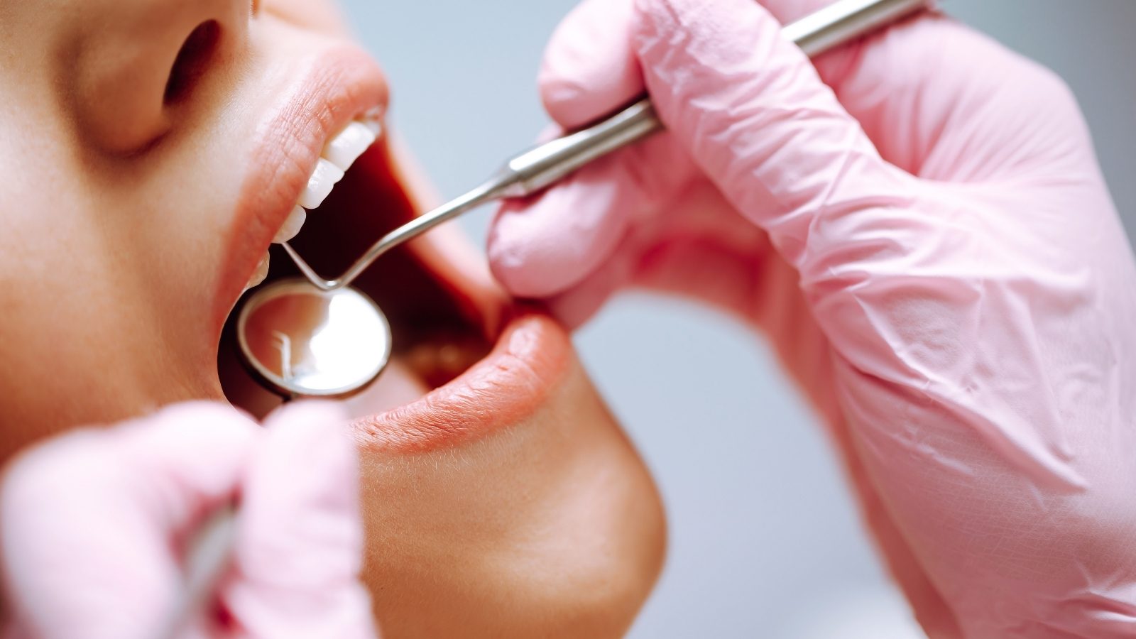 Un examen en cours : le miroir et la sonde du dentiste parcourent les dents du haut.