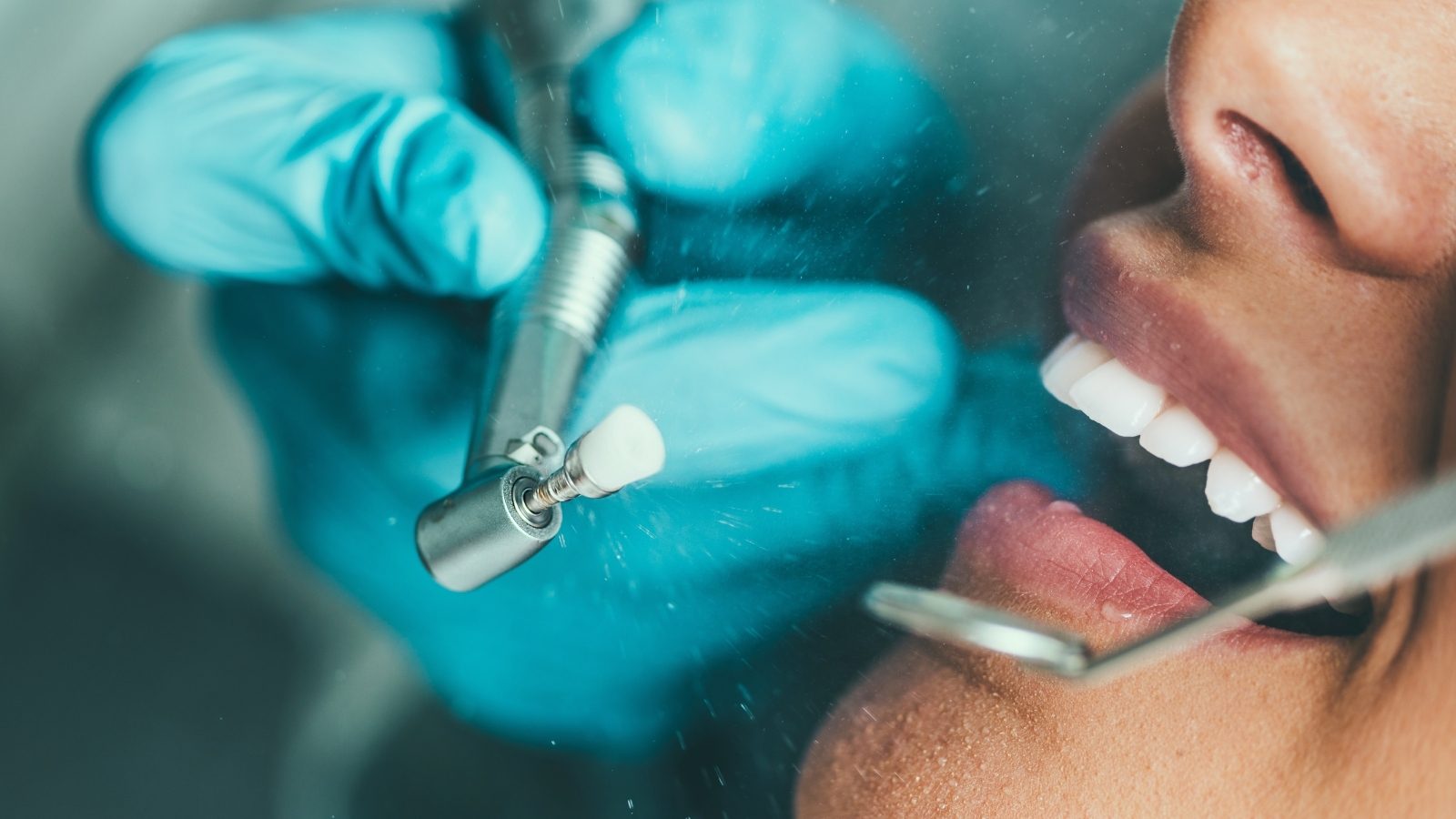 Un détartreur à ultrasons et un miroir nettoient les dents d’un patient.