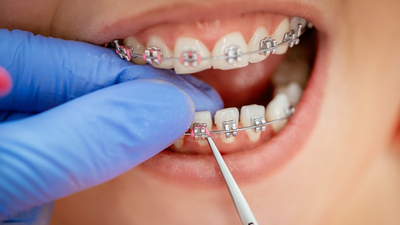 Des broches posées sur les dents du haut, ajustées avec un instrument.