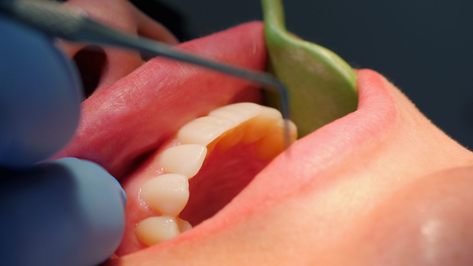 Un écarteur dégage la bouche pendant qu’un instrument travaille sous la gencive.